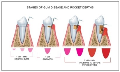 Gum Disease