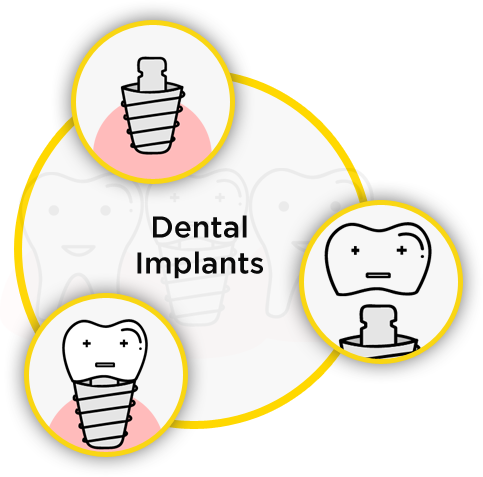 Arudhra Dental Care - Implants
