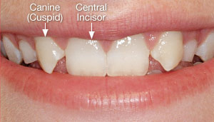 upper canine teeth