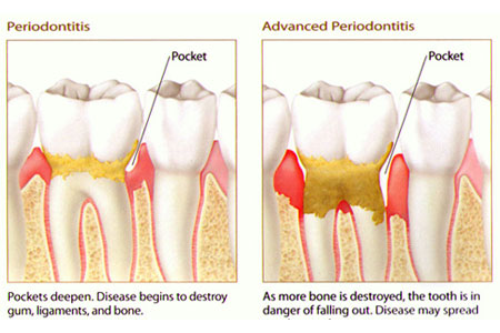 Deep Pockets in gums - Arudhra dental care