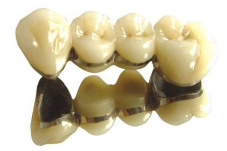 PFM Crowns