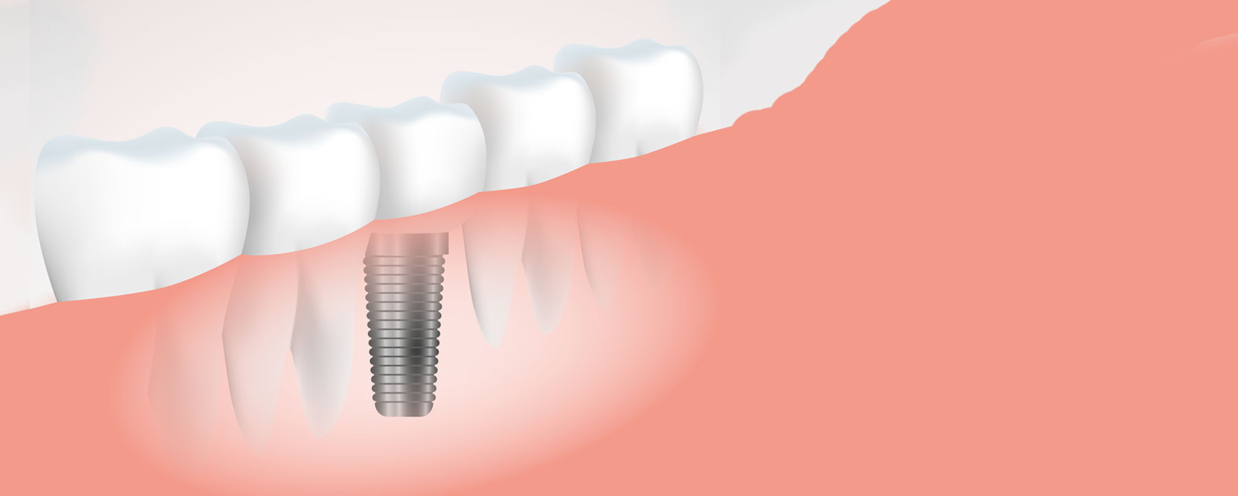 Implant