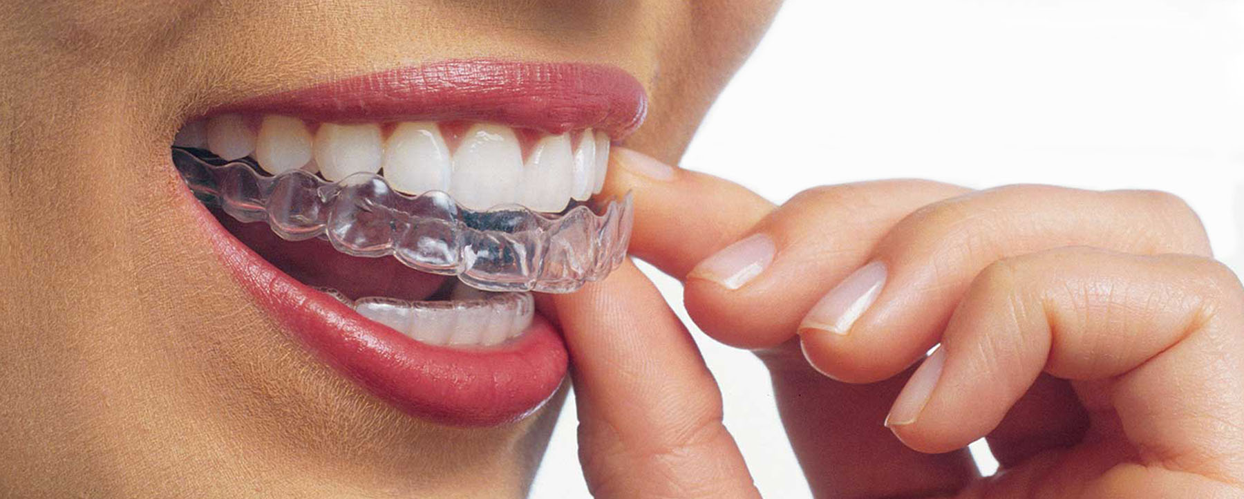 Braces