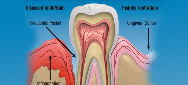 Gum Disease
