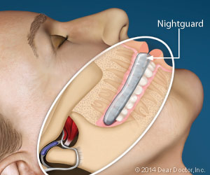 Gum Disease