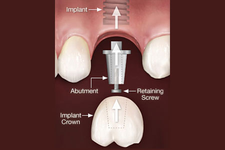 Dental Implants