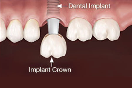 Dental Implants