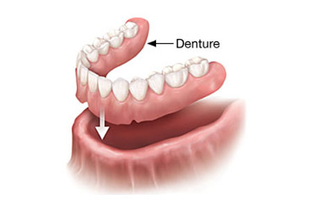 Dental Implants