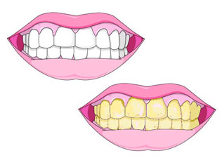 Gum Disease
