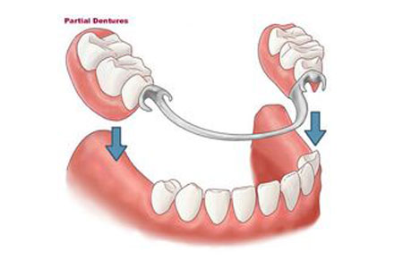 Removable Partial Denture
